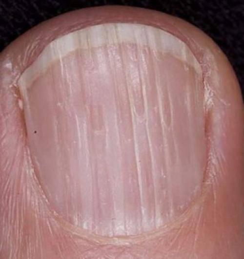 Почему на ногтях появляются чёрные полоски? черные полоски под ногтями как занозы