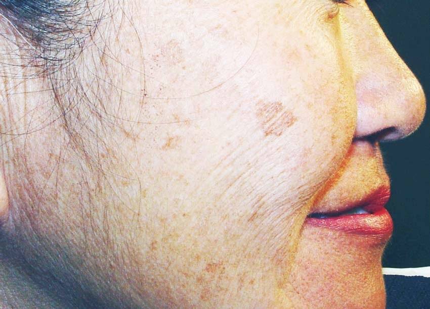 Пигментные пятна на лице: причины и лечение в кабинете косметолога и народными средствами