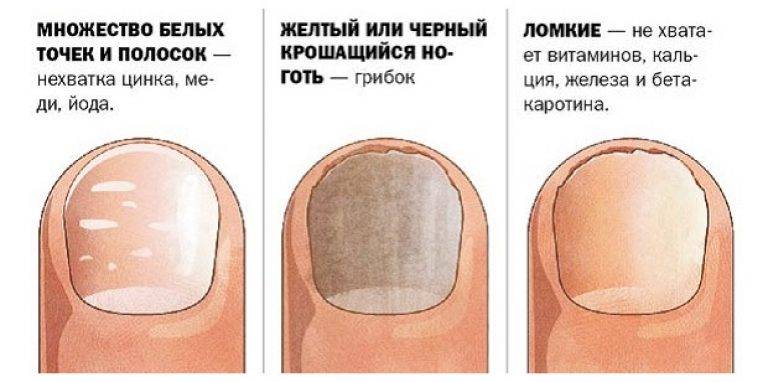 Белые пятна на ногтях — что это означает, причины. приметы, к чему белые пятнышки на ногтях