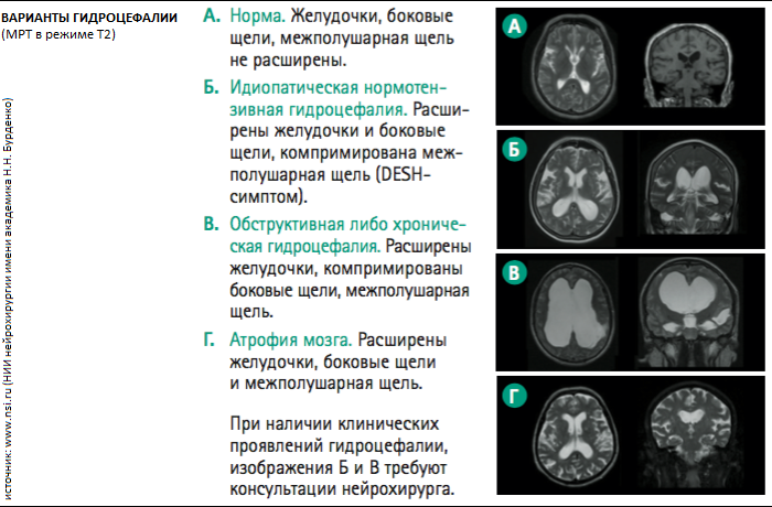 Синдром Хакима-Адамса нормотензивная гидроцефалия. Кт признаки гидроцефалии мозга. Внутренняя гидроцефалия на кт головного мозга. Кт атрофия мозга наружная гидроцефалия.