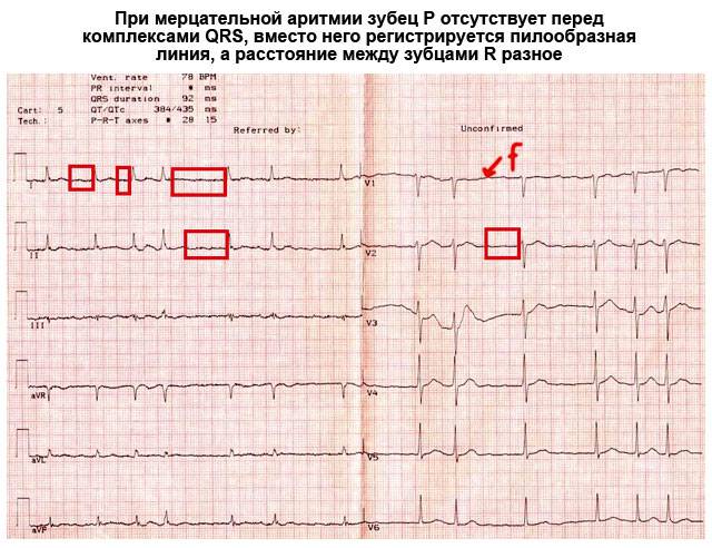 Компьютерное заключение синусовый ритм что это