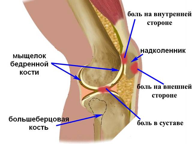 Болит колено с внутренней стороны сбоку: почему и как лечить ногу