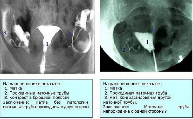 Непроходимость маточных труб: что это такое. причины, симптомы и лечение непроходимости маточных труб |
            эко-блог