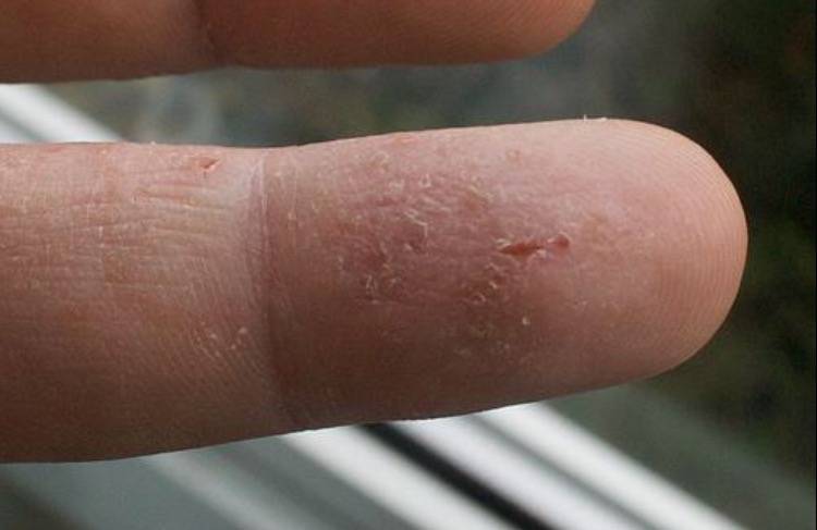Сухость кожи на руках: причины появления трещин, сухости, лечение трещин на руках, крема от сухости, мази