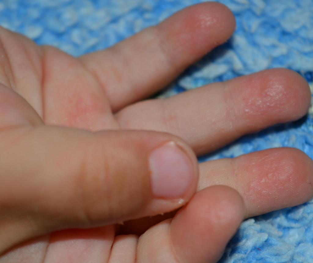 Шелушатся ладошки у ребенка. почему шелушится кожа на ладонях рук