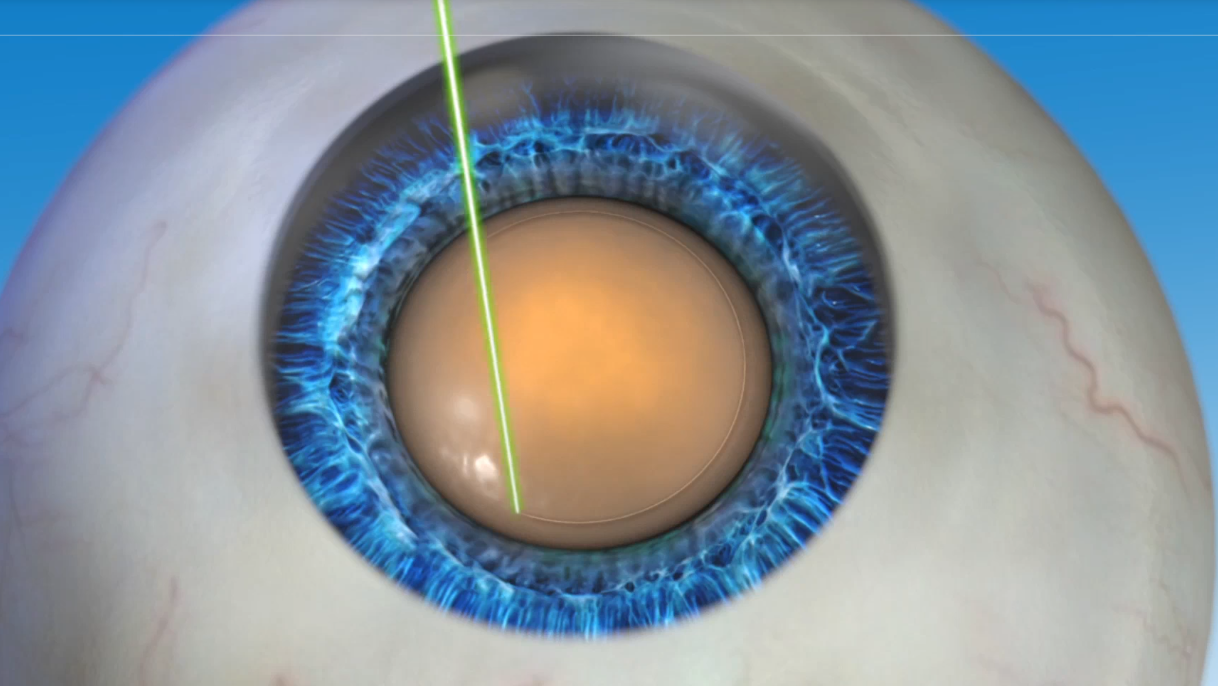 Катаракта факоэмульсификация. Лазерная экстракция катаракты офтальмология. Глазная операция глаукомы