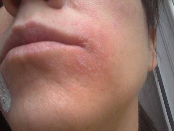 На носу сухая кожа. причины шелушения носа