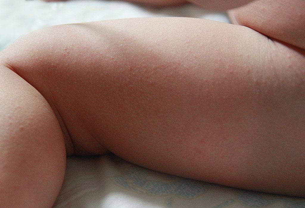 Потница у новорожденных (33 фото): как выглядит инфицированная потничка, каковы симптомы у грудничка, в 8 месяцев и до года, виды и как проявляется