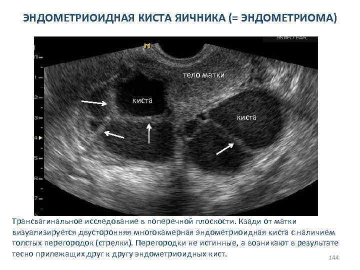 Киста жёлтого тела при беременности: симптомы, лечение