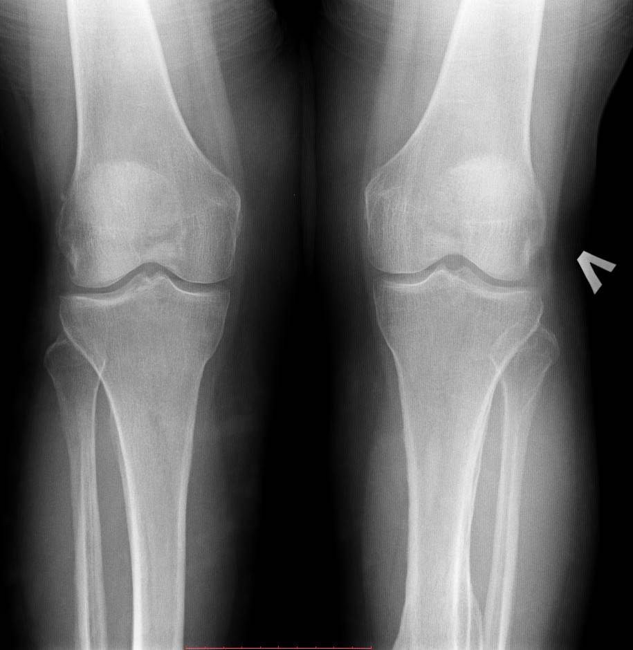 Рентген колена. Мениск коленного сустава рентген. Менископатия коленного сустава рентген. Повреждение мениска рентген. Разрыв мениска снимок рентген.