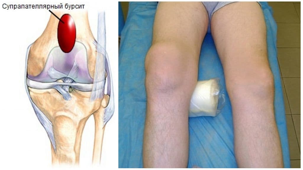 Супрапателлярный бурсит коленного сустава: что это такое, симптомы и лечение