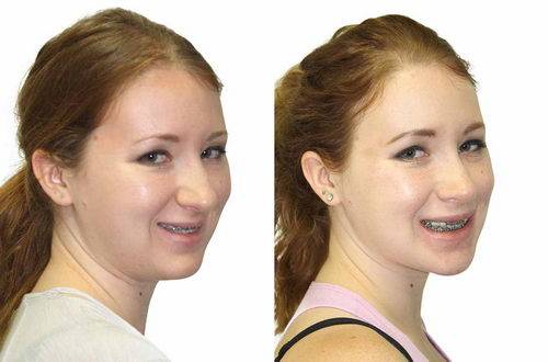 Лицо до и после брекетов - профимед - эстетическая стоматология