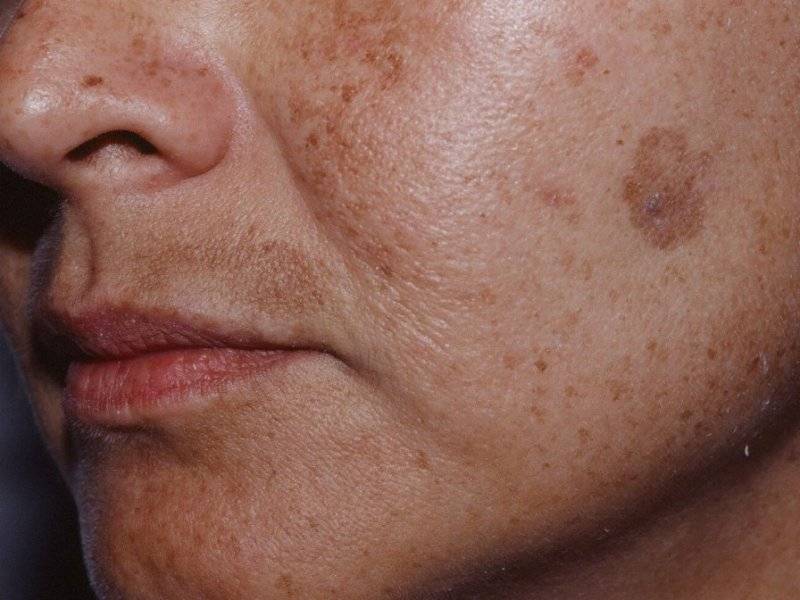 Пигментные пятна на лице: виды и причины, как избавиться при помощи косметических средств, лечение пигментации кожи в салоне, фото