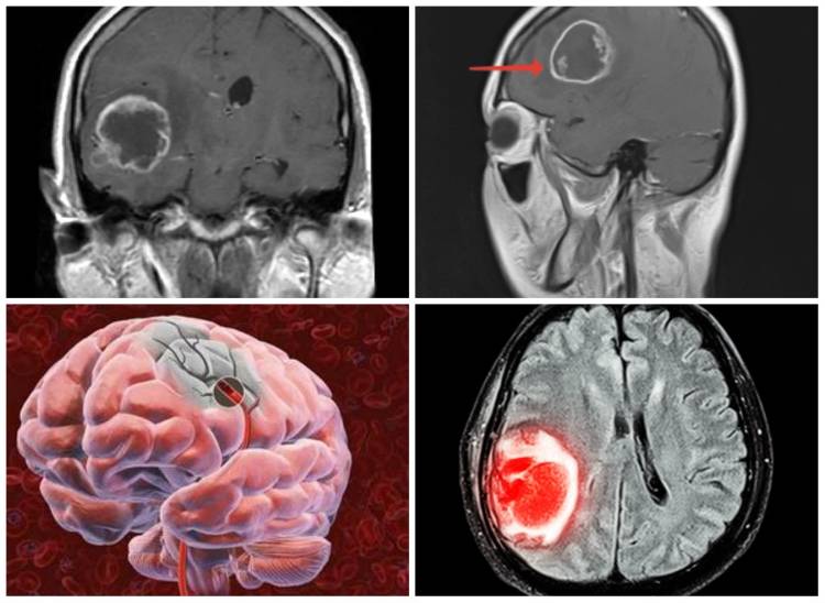 Метастазы в головном мозге: симптомы, продолжительность жизни