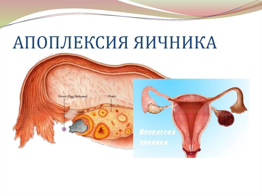 Апоплексия яичника: причины, симптомы, лечение, прогноз и профилактика.