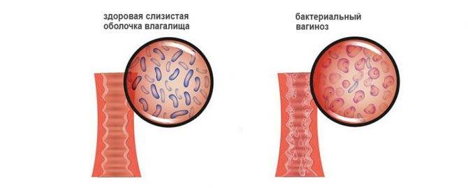 Микоплазмоз: симптомы у мужчин и женщин, лечение антибиотиками