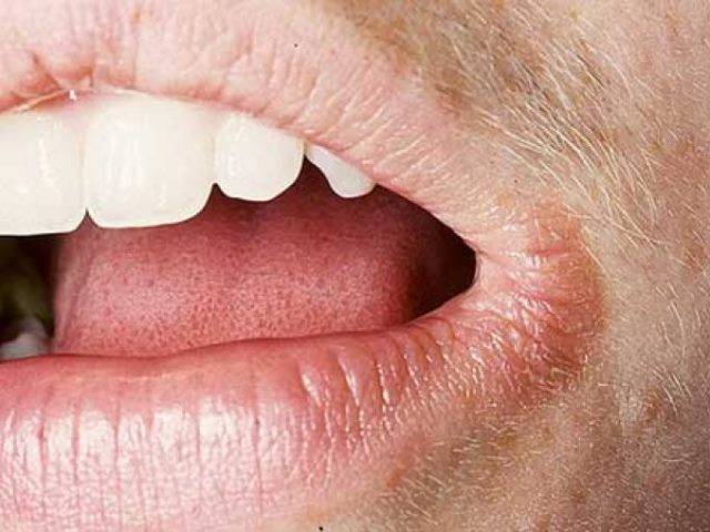 Трескаются уголки губ: причина, лечение рта, чем лечить у детей, если сохнут и болят, почему появляются трещины у взрослого, из-за чего лопаются у ребенка