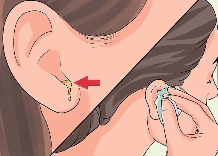 Причины появления и лечение воспалительных процессов в слуховом проходе