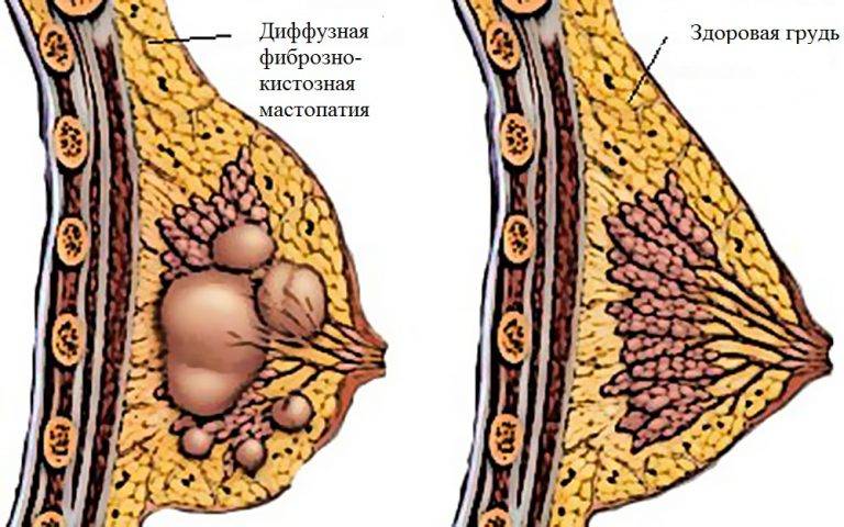 Лечение узловой фиброзно-кистозной мастопатии и причины развития заболевания у женщин