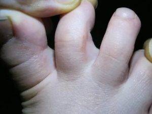 Трещины между пальцами ног. причины и лечение, фото мокнущие, глубокие, шелушение возле ногтей, зуд, неприятный запах. лекарства, препараты, мази, народными средствами в домашних условиях