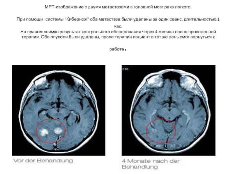 Метастазы в головной мозг при раке легких: сколько живут, симптомы и лечение