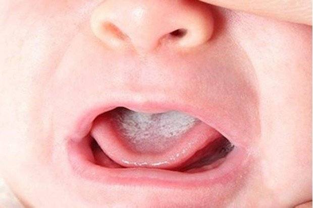 Чем лечить молочницу во рту у взрослых лучше всего?