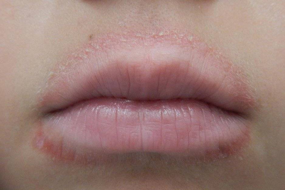 Почему шелушится кожа на носу: причины, методы лечения
