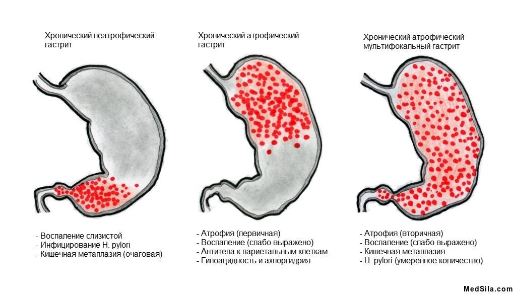 Что такое атрофический гастрит желудка: симптомы и лечение