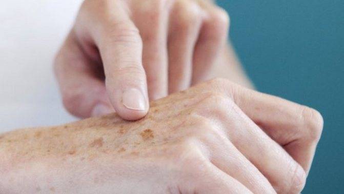Как избавиться от пигментации на лице: убрать пигментные пятна на руках и теле, причины старческих, возрастных, удаление коричневых