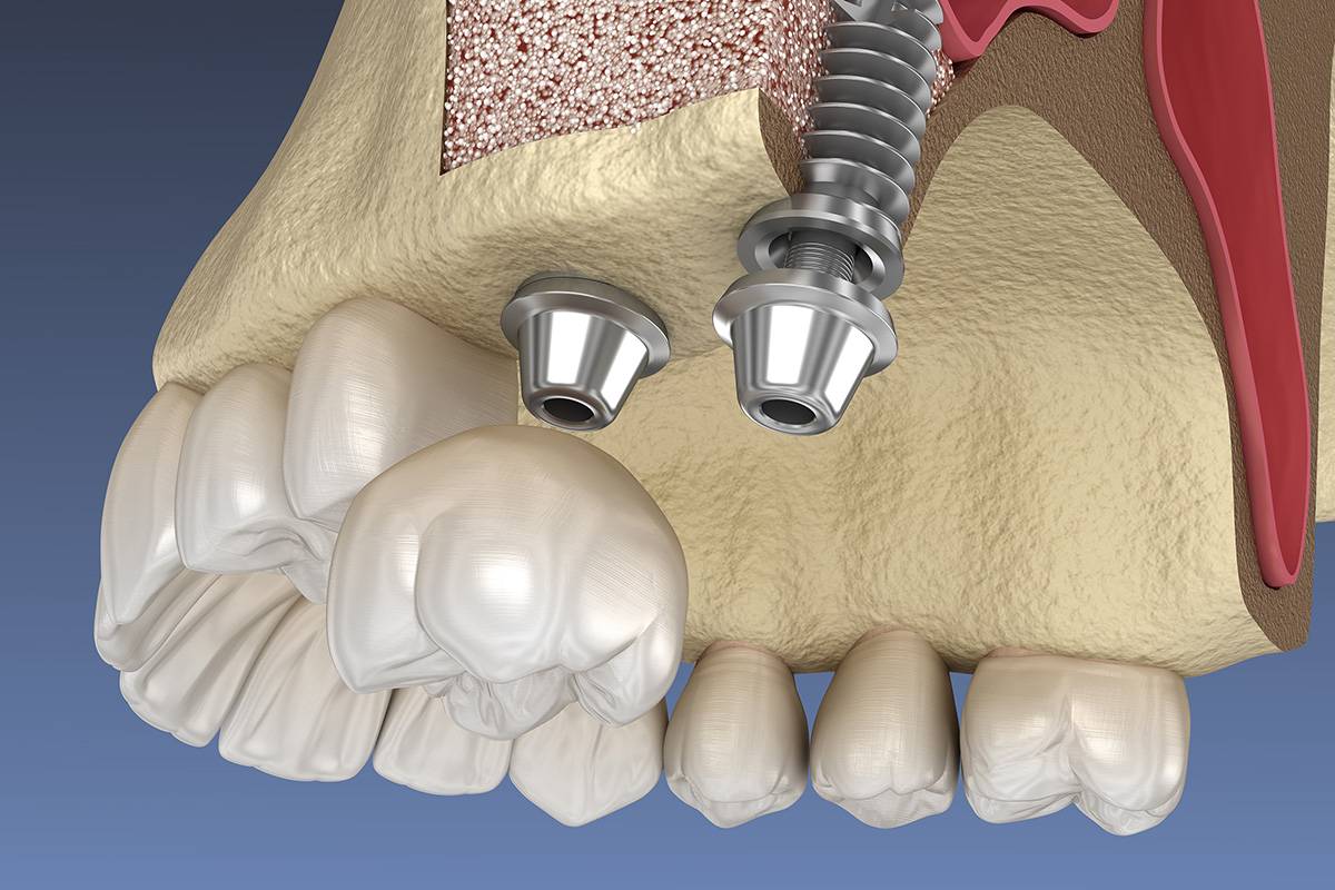 Когда требуется наращивание костной ткани при такой процедуре, как имплантация зубов, о чем говорят отзывы