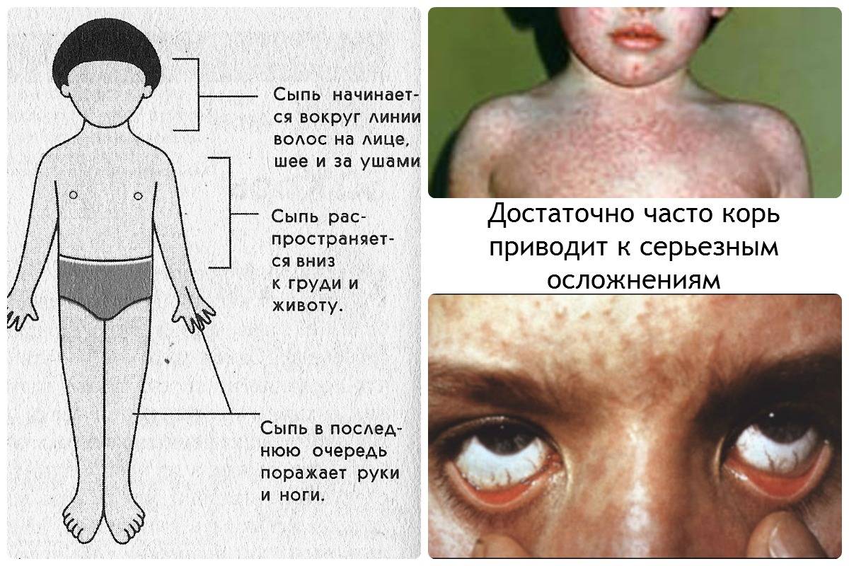 Как проявляется корь у детей: фото симптомов, причины, помощь при кори и лечение заболевания