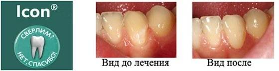 Кариес корня зуба: лечение, симптомы, стадии и профилактика