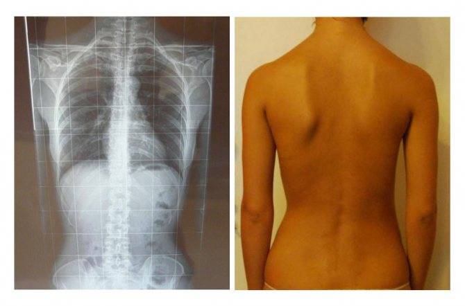 Правосторонний и левосторонний сколиоз грудного отдела позвоночника: симптомы и лечение