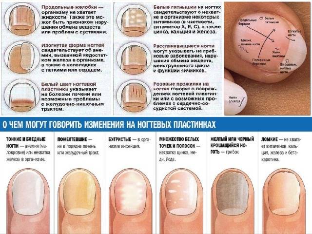 Вмятины на ногтях на пальцах: причины, лечение и фото, также почему на руках появляются поперечные ямки, о чем говорят дырочки?