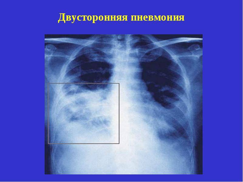 Двухсторонняя пневмония: симптомы, лечение и последствия