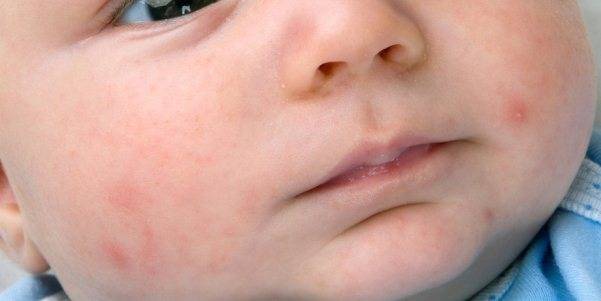 Аллергическая сыпь и красные пятна у взрослых