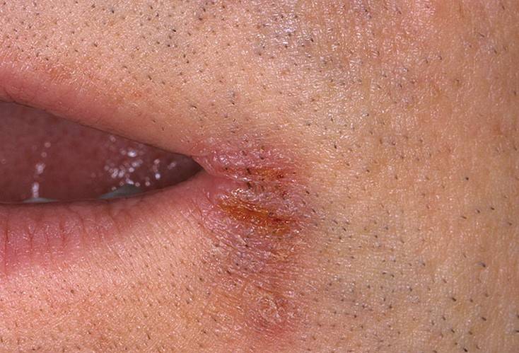 Трещины в уголках рта (ангулярный хейлит): фото, все причины