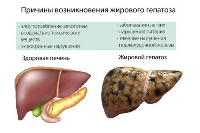 Сроки восстановления печени при жировом гепатозе - лечение печени