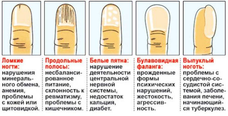 Желтые ногти на ногах, причины и методы лечения болезни
