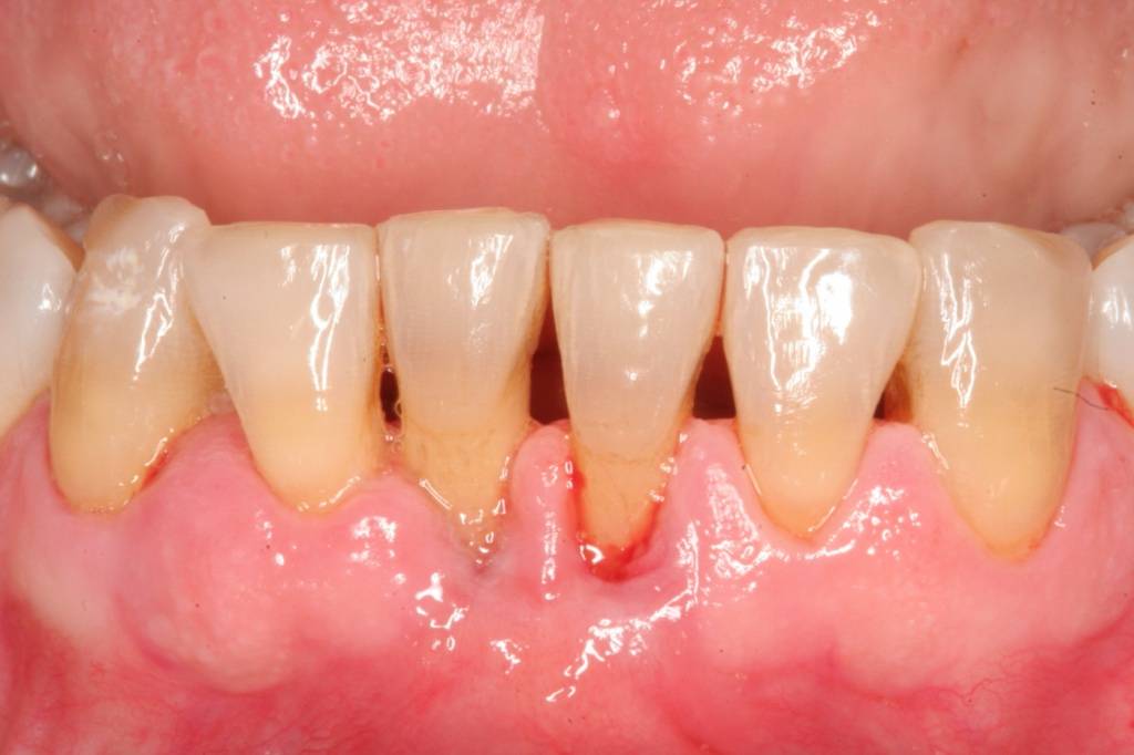 Дёсны отходят от зубов - что делать? причины и лечение (в т.ч. народными средствами)