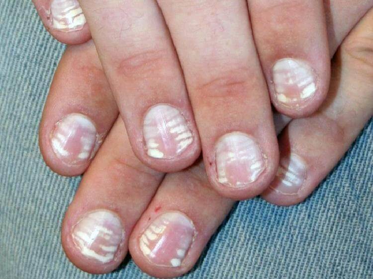 Ониходистрофия (дистрофия) ногтей: лечение, причины возникновения у женщин и мужчин на ногах и руках, фото, каналообразная, срединная и другие виды