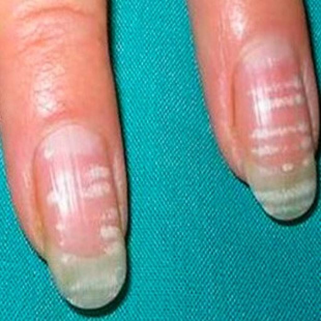 Диагностика здоровья по ногтям пальцев рук. фото