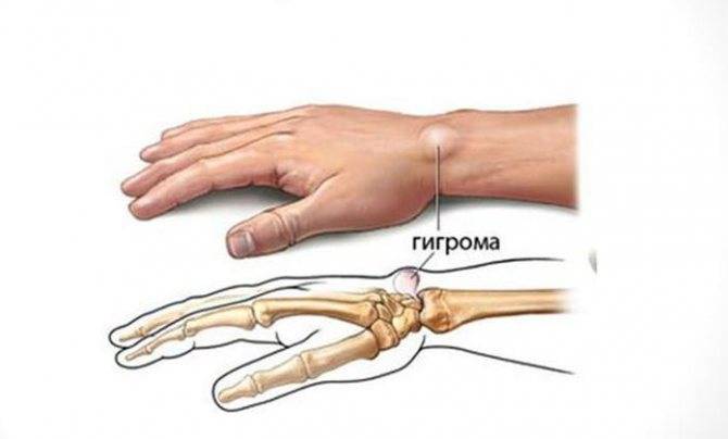Гигрома (шишка) запястья: причины и лечение без операции твердой шишке на кисти руки, как лечить нарост с внутренней стороны если появился