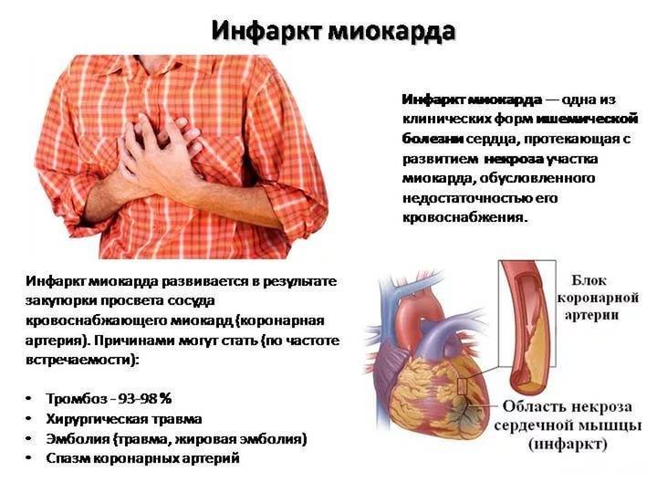 Какие симптомы при инфаркте миокарда (у женщин, у мужчин)?
