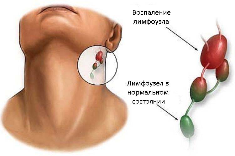 Воспаление лимфоузлов на шее: лечение, причины, симптомами каких заболеваний является, фото