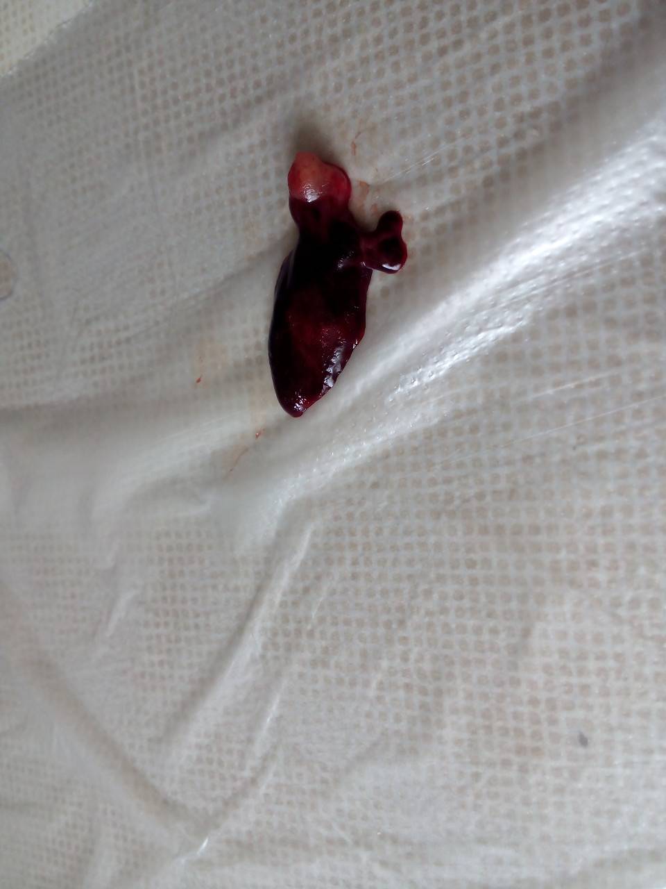 сгустки крови в моче и сперме у мужчин фото 118