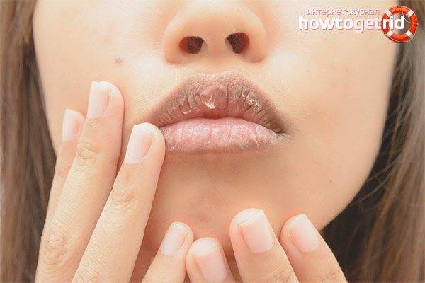 Почему трескаются уголки губ и как лечить: самые эффективные способы