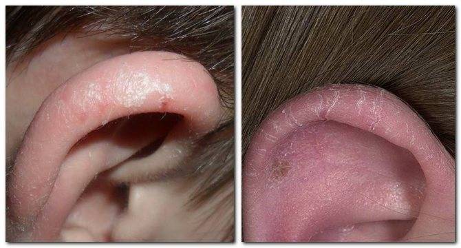 У ребенка грязные уши каждый день - причины и лечение