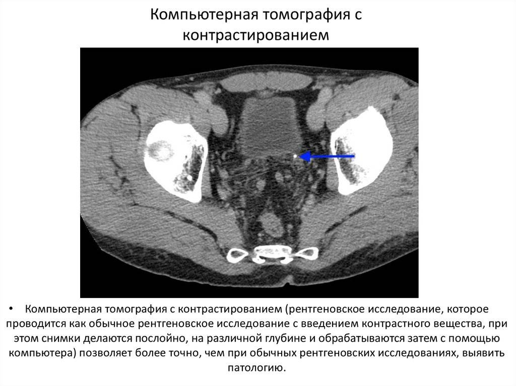 Кт брюшной полости с контрастом: что это такое, для чего и как делают томографию органов, что покажет, подготовка, цена, прием внутрь урографина перед процедурой