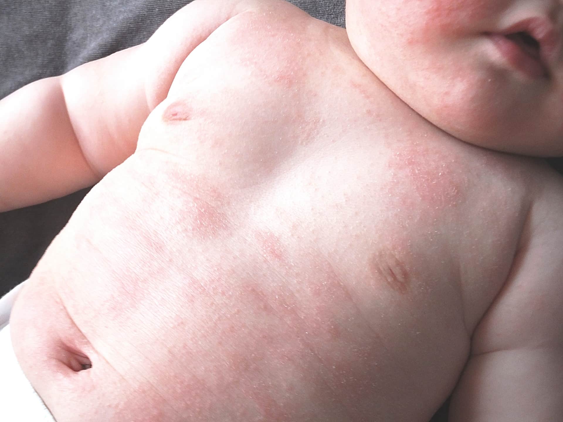 Перианальный дерматит у новорожденного лечение
